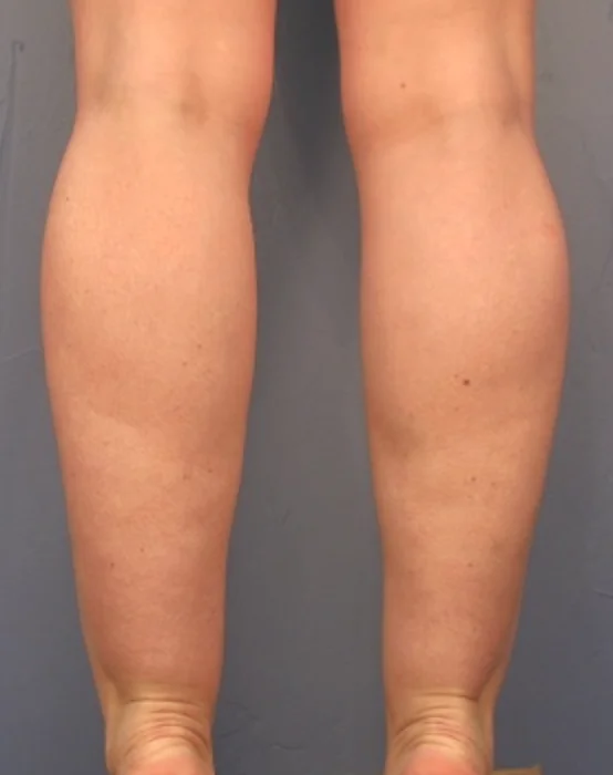 Cankle Treatments London - Get Causes, Solutions, Costs and Before