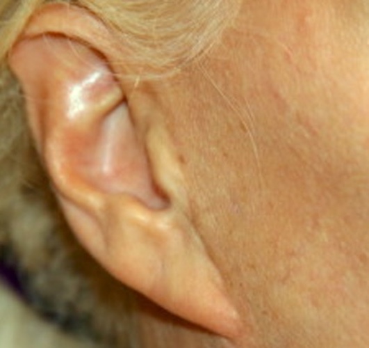 Pixie Ear
