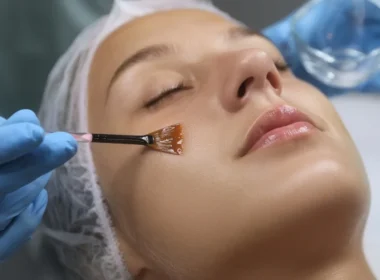 chemical peel doing on girl's face