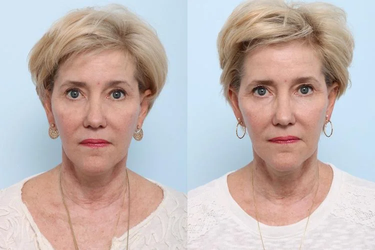 Juvederm Voluma B&A