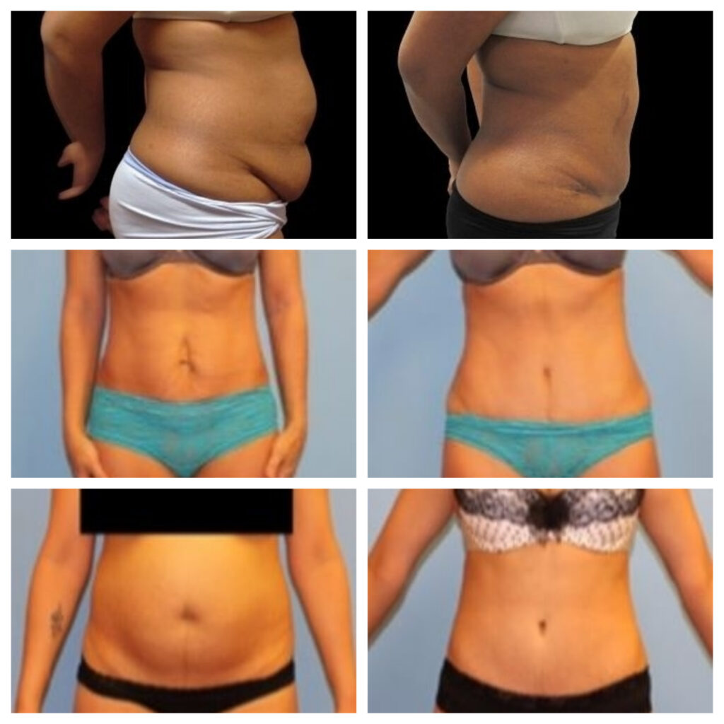 Tummy Tuck before and after
