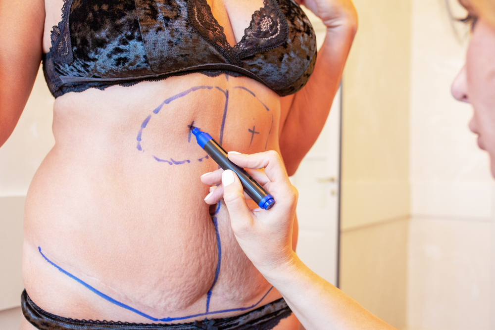 liposuction vs. tummy tuck