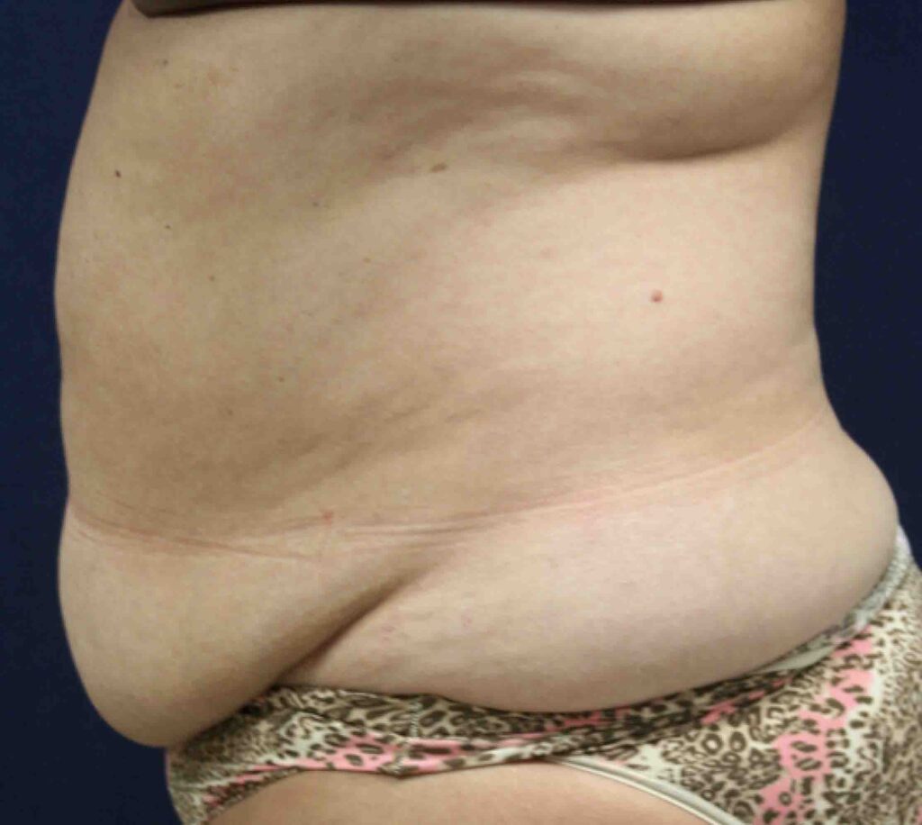 Before-Panniculectomy-Surgery