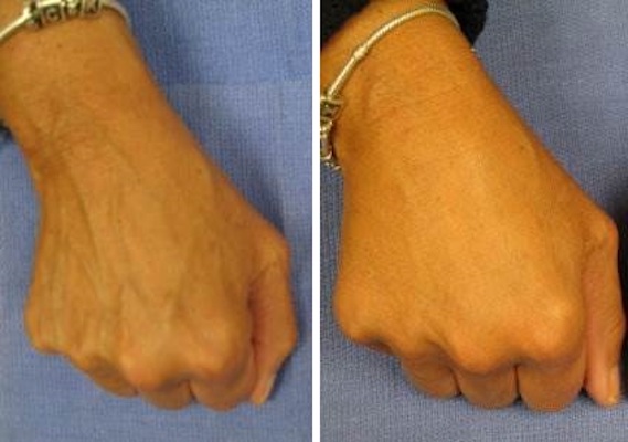Before and after Radiesse to hands