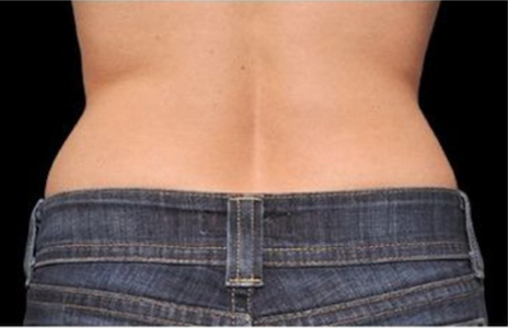coolsculpting after flanks