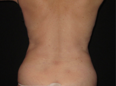 coolsculpting after flanks