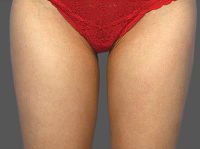 coolsculpting after outer thighs