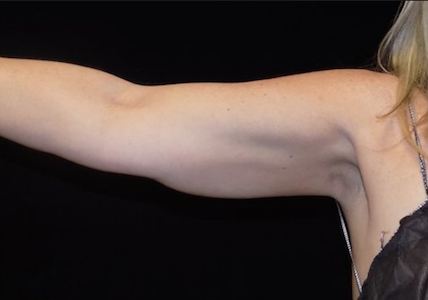 coolsculpting arms after