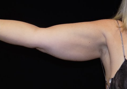 coolsculpting arms before