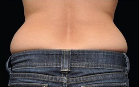 coolsculpting before flanks