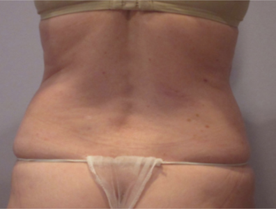 coolsculpting before flanks