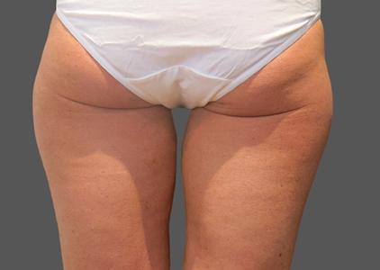 coolsculpting outer thighs before