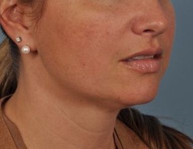 coolsculpting chin after
