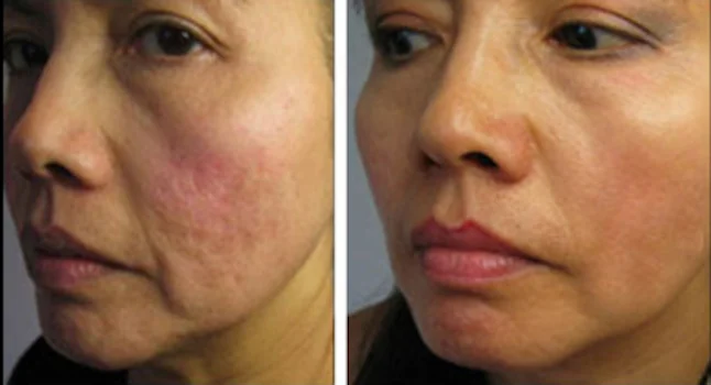 Microneedling B&A