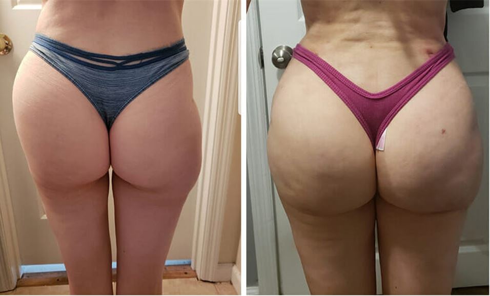 Is a fat transfer to hips dangerous? (photo)