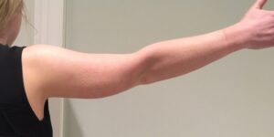 Arm liposuction