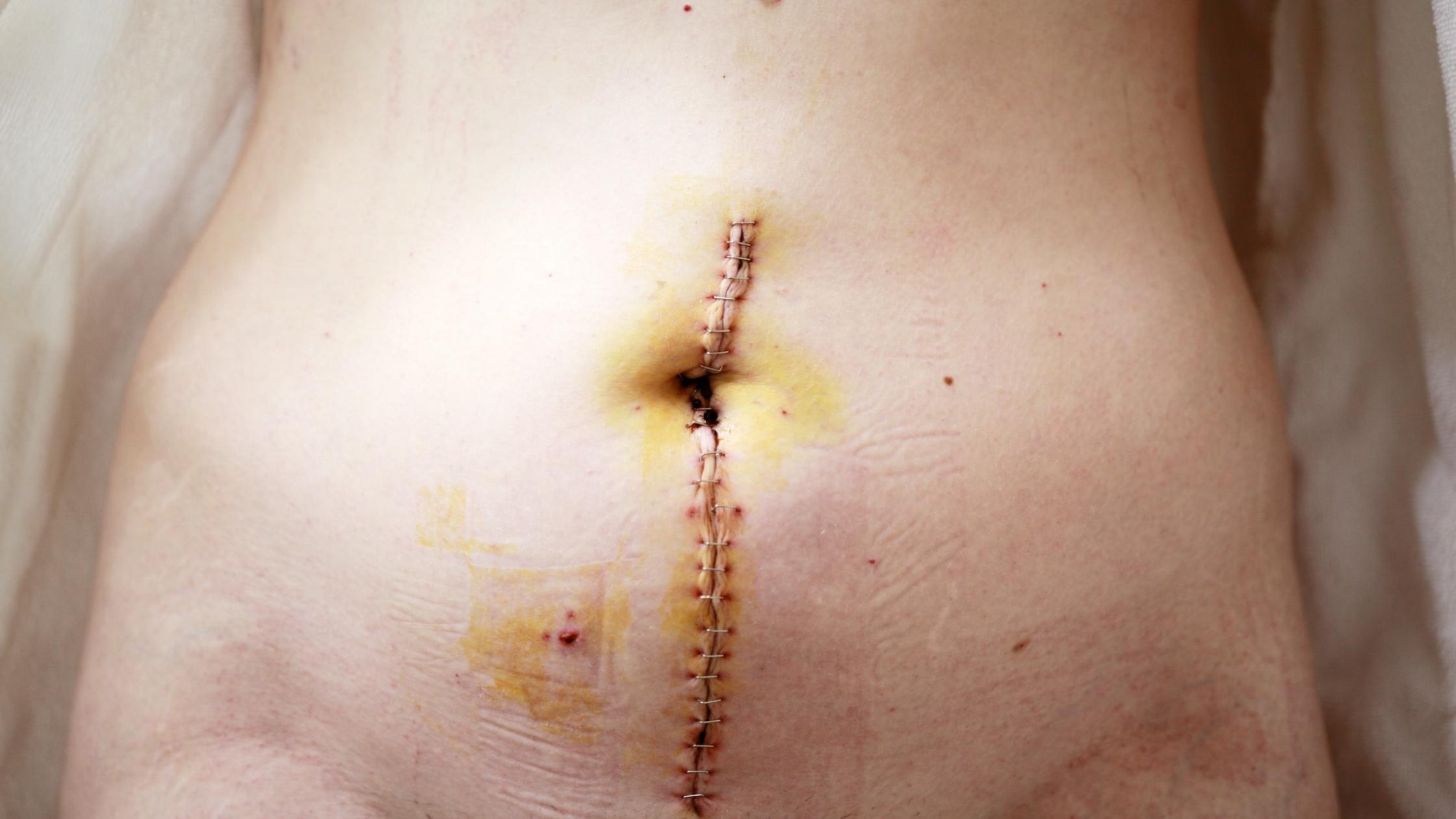 Hysterectomy Scars