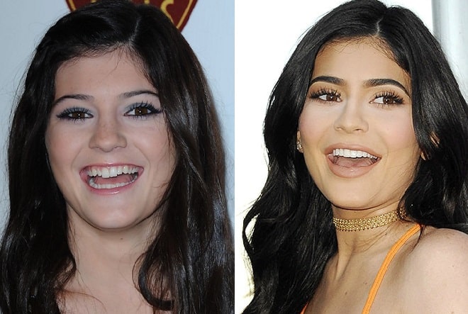 Kylie-Jenner-before-and-after-veneers-min