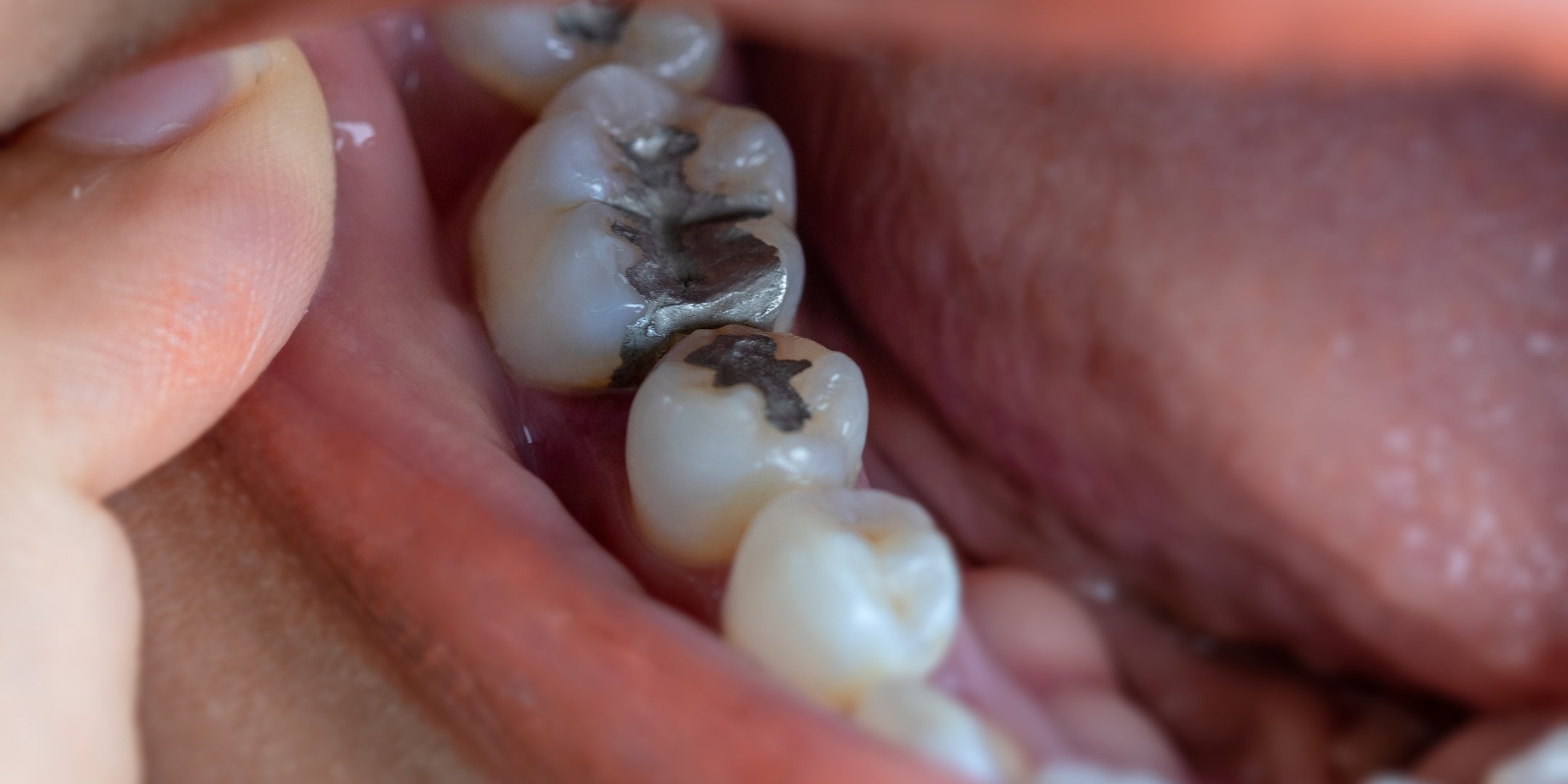 Loose Dental Filling: What Should You Do When You Spot It?