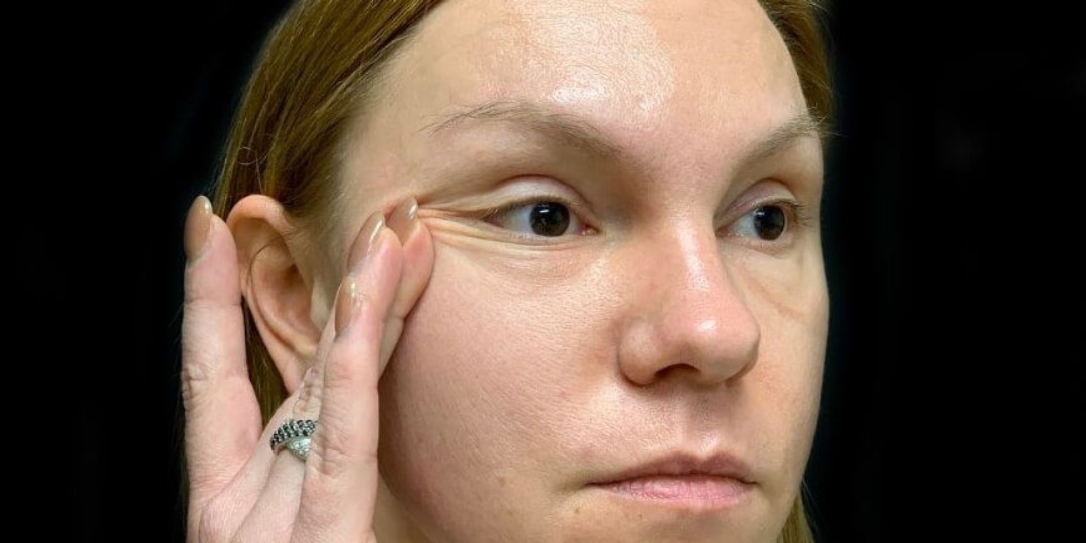 Malar Festoons Exercises: First Step To Treat Eyelid Bags