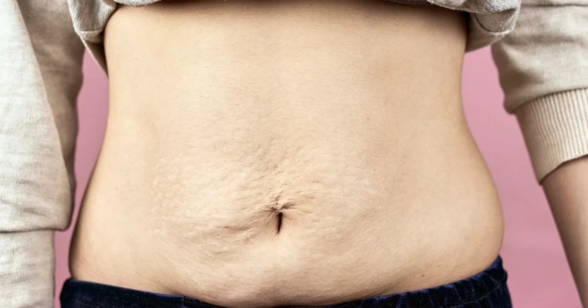 Fibrosis after Lipo