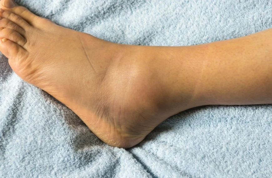 liposuction on calves and ankles