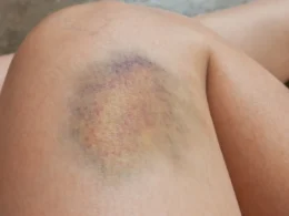 bruise discoloration on the thigh